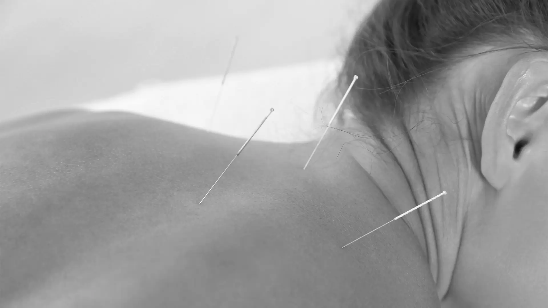 Frau mit Akupunkturnadeln im Rücken